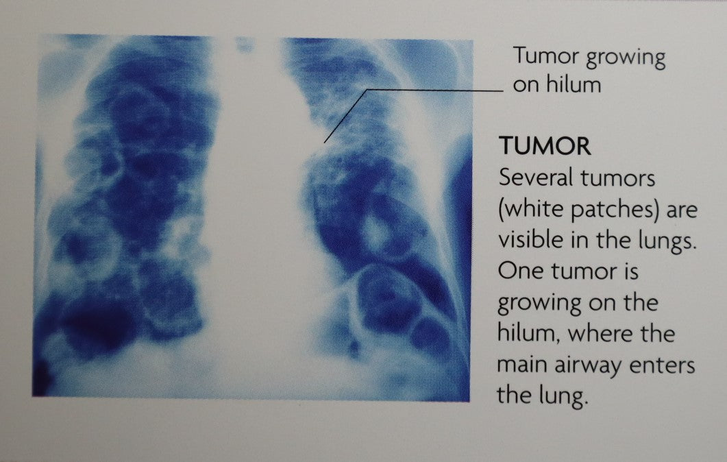 Giant Puffballs: Can They Really Reduce the Risk of Cancer?